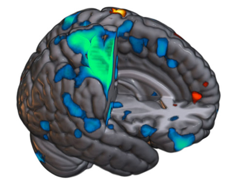 Brain scan showing highlighted regions of the brain
