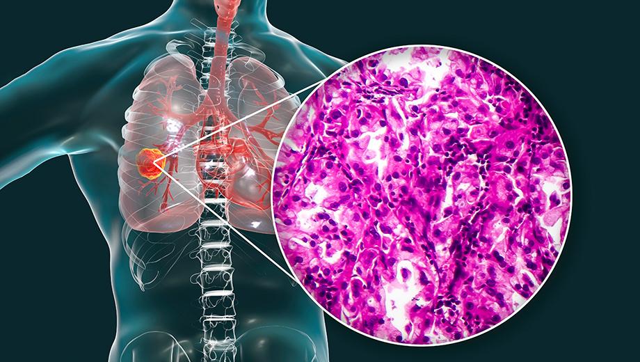 Non-small cell lung adenocarcinoma  magnified and diagram where it appears in the body