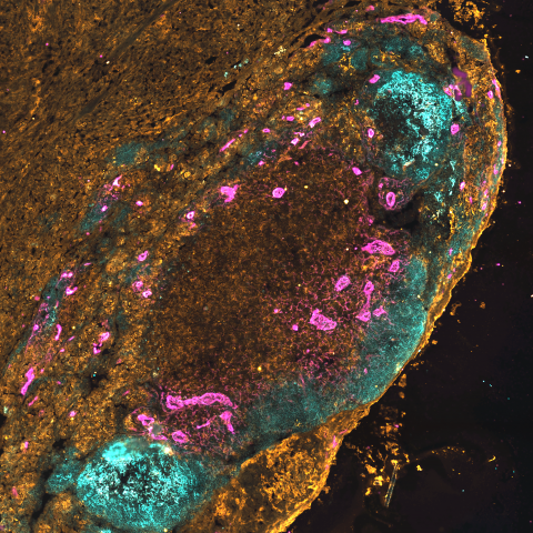 Microscopic image of mouse ovarian tumor 