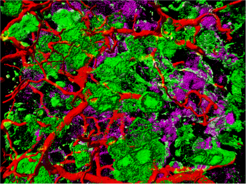 Microscopic image of endometrial adenocarcinoma