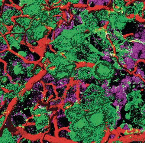 Microscopic image of endometrial adenocarcinoma