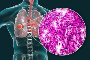 Non-small cell lung adenocarcinoma occurs in the glandular tissue of the lung and is illustrated here with a histopathology light micrograph and the structure of Thomas’ aptamer used in their study. 